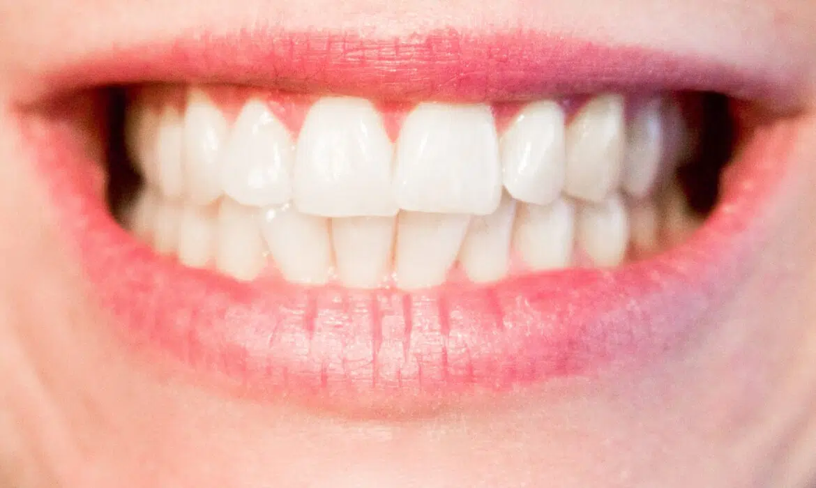 Blanchiment de dents : combien ça coûte ?