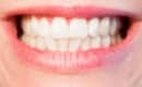 Blanchiment de dents : combien ça coûte ?