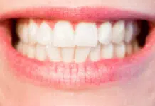 Blanchiment de dents : combien ça coûte ?