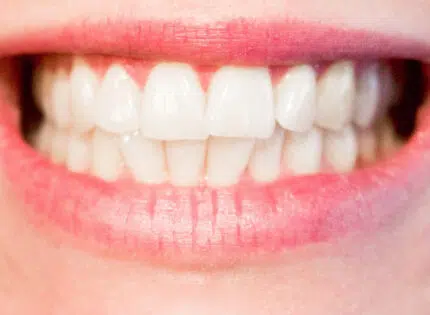 Blanchiment de dents : combien ça coûte ?