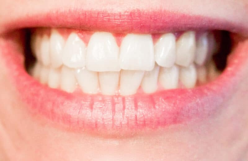 Blanchiment de dents : combien ça coûte ?
