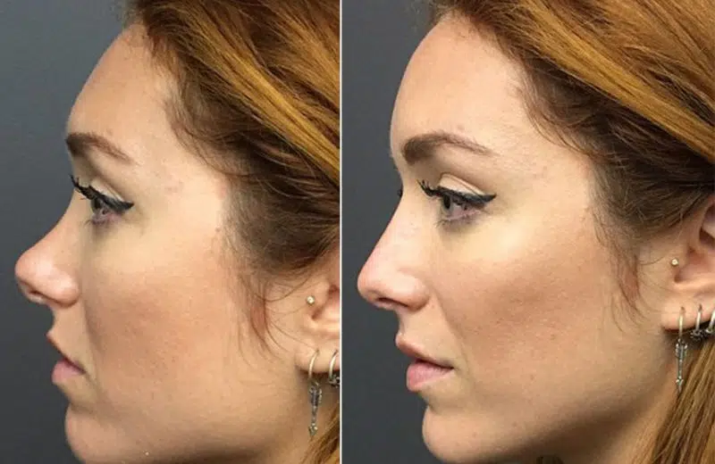 Comment ne pas payer une rhinoplastie ?