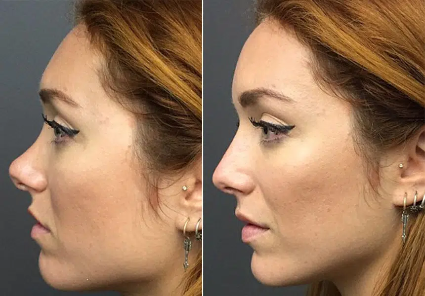 Comment ne pas payer une rhinoplastie ?